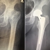 Врачи-травматологи-ортопеды ГКБ №67 выполнили операцию по замене тазобедренного сустава 91-летней пациентке