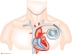 Аритмологи ГКБ №67 установили более 20 кардиостимуляторов 